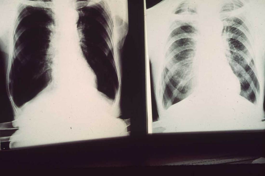 Black lung x-rays from patients of Dr. A.H. Russakoff pulmonary disease specialist and pioneer air pollution fighter in the area, July 1972.